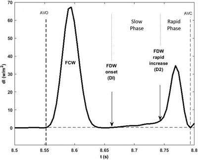 Mechanisms of Aortic Flow Deceleration and the Effect of Wave Reflection on Left Ventricular Function